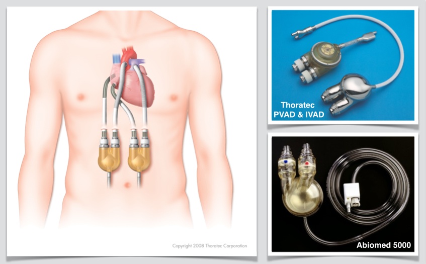 Fig. 5: Contemporary bi-ventricular assist devices (BiVAD)