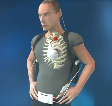 Fig. 3: Graphical representation of the CARMAT TAH system carried by the patient. The 2 batteries are visible under the armpits, the console is carried at the belt. The connection to the implanted device is on the skull behind the ear of the patient.