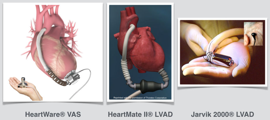 Fig. 4: Contemporary  left ventricular assist devices (LVAD)