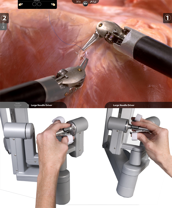 Fig. 3: Le mani del chirurgo utilizzando le manopole e l'immagine corrispondente degli strumenti con delle articolazioni nel corpo del paziente (immagine da Intuitive Surgical, Sunnyvale,, CA, USA).