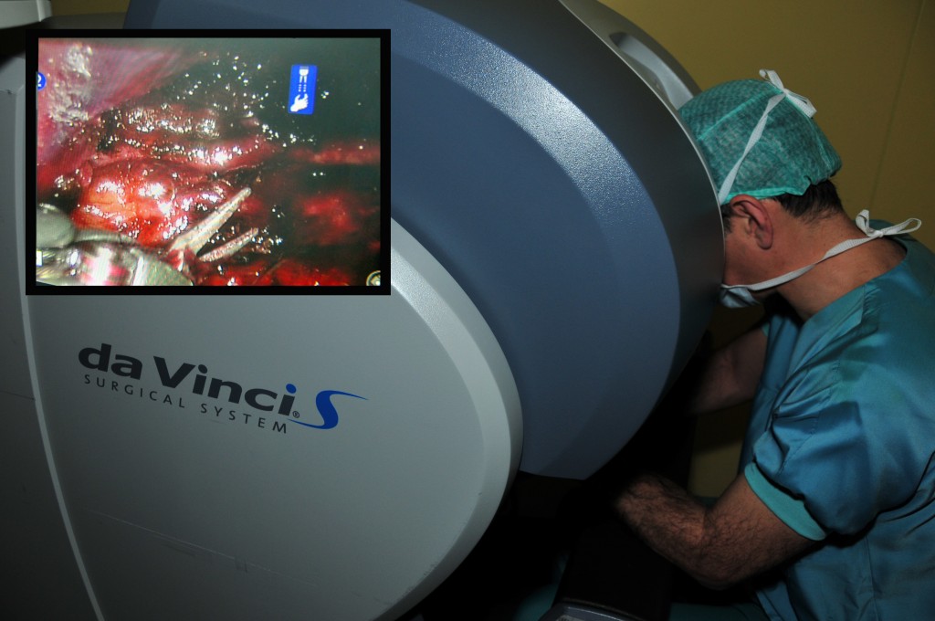 L'autore del blog alla console del da Vinci S - inserita anche l'immagine attuale a questo momento (la preparazione dell'arteria mammaria interna sinistra - Ospedale Universitario Inselspital Berna, 2010)